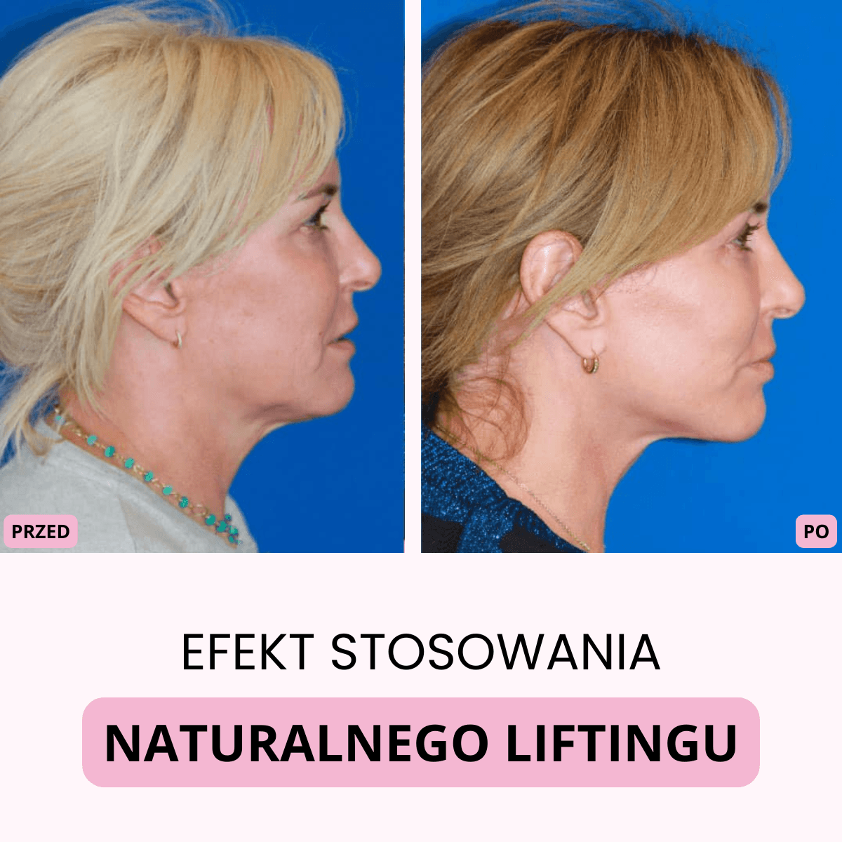 AERI – Naturalny lifting twarzy w 5 minut